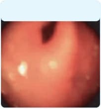 Upper airway during a laryngeal angioedema attack.