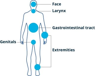 Graphic showing where HAE attacks can occur in the body: face, larynx, gastrointestinal tract, genitals, and extremities.