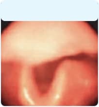 Upper airway without an HAE attack.