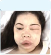 Woman's swollen face during an HAE attack, which can include swelling of eyes and lips.