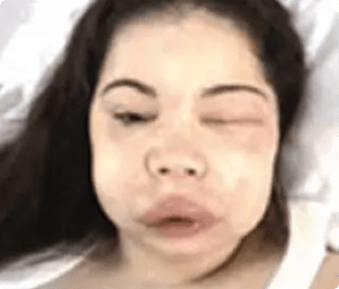 Photo of a patient during a hereditary angioedema (HAE) attack causing swelling of the face.